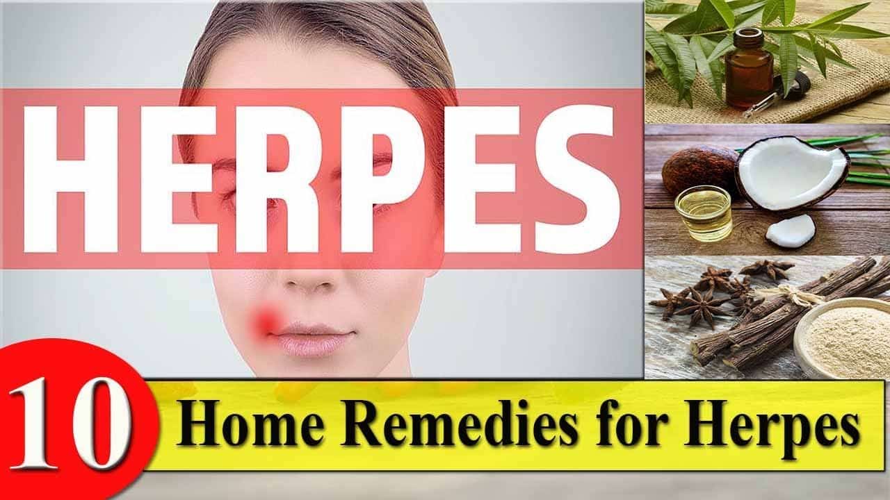 10 Home Remedies for Herpes