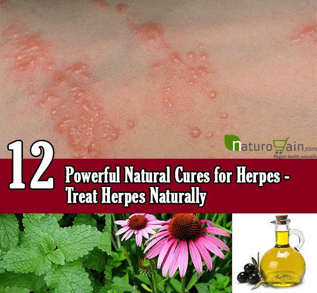 12 Powerful Natural Cures for Herpes