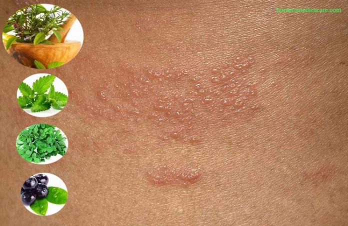 15 Home Remedies to Get Rid of Herpes Faster and Preventions