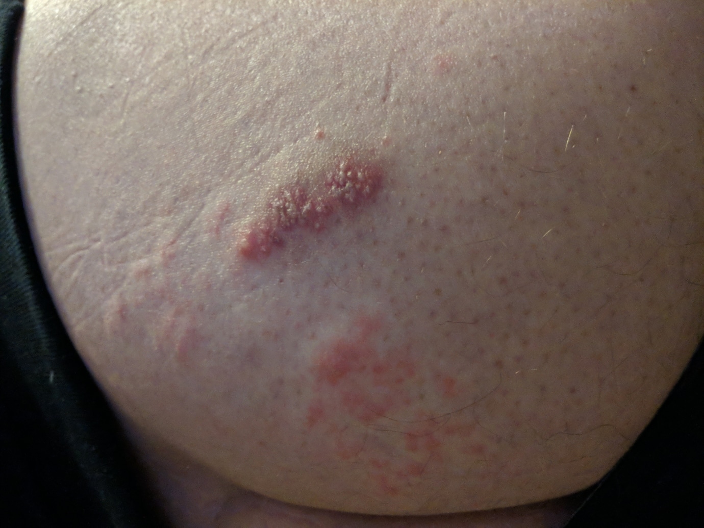 1st rash only on butt cheek?