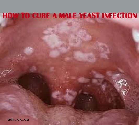 2097 best symptoms of a yeast infection images on Pinterest