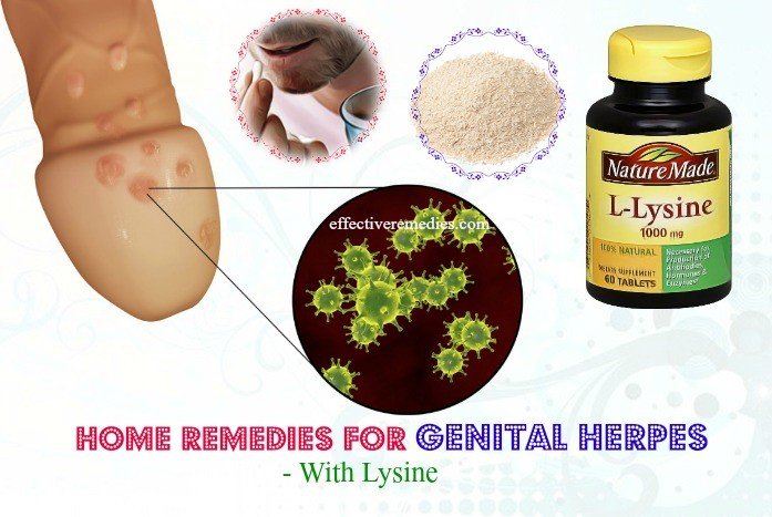 27 Effective Home Remedies For Genital Herpes â Natural &  Safe
