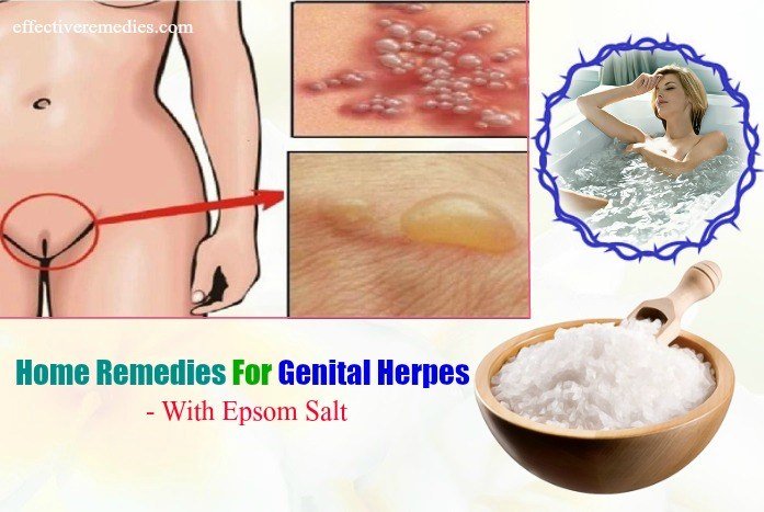 27 Effective Home Remedies For Genital Herpes  Natural &  Safe