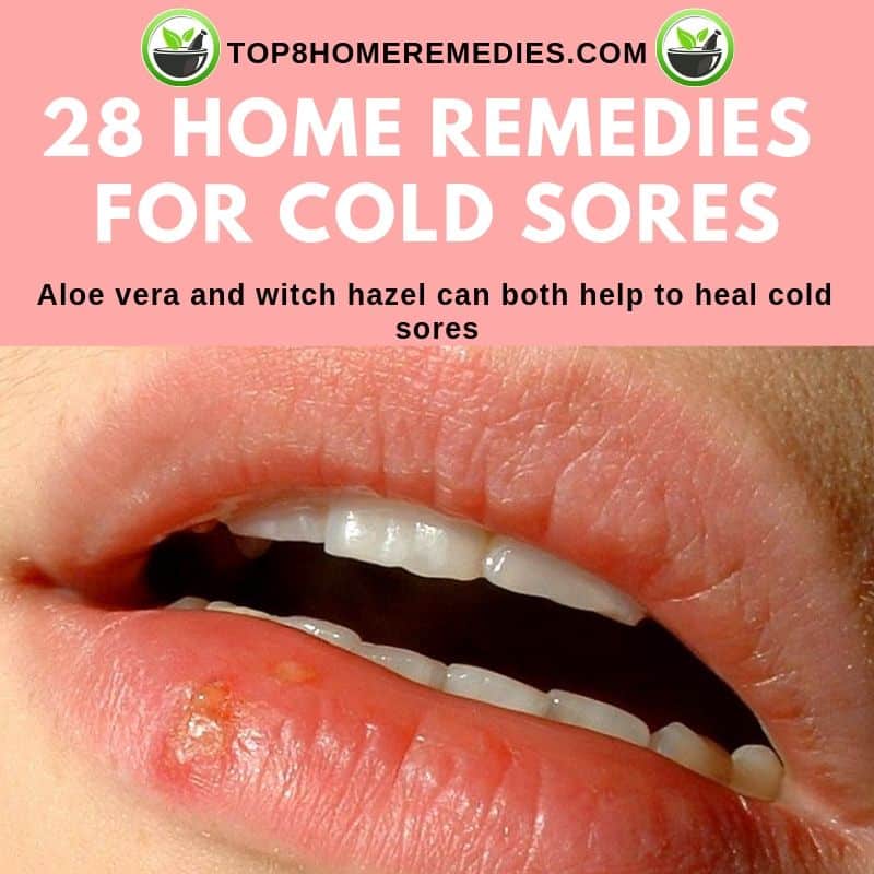 28 Home Remedies for Cold Sores