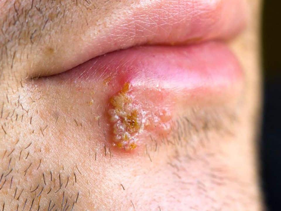 3 quick ways to deal with herpes » SelectDeals