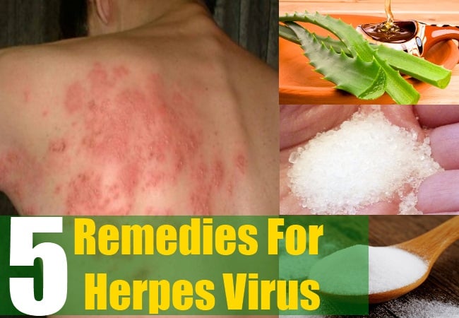 5 Natural Cure For Herpes Virus