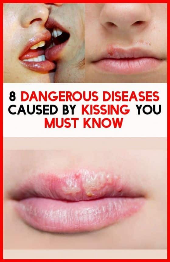 8 Hazardous diseases you must know caused by kissing in 2020