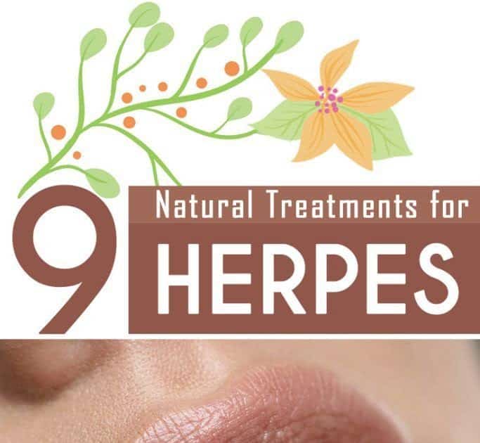 9 Amazing Natural Treatments for Herpes that you can try at home # ...