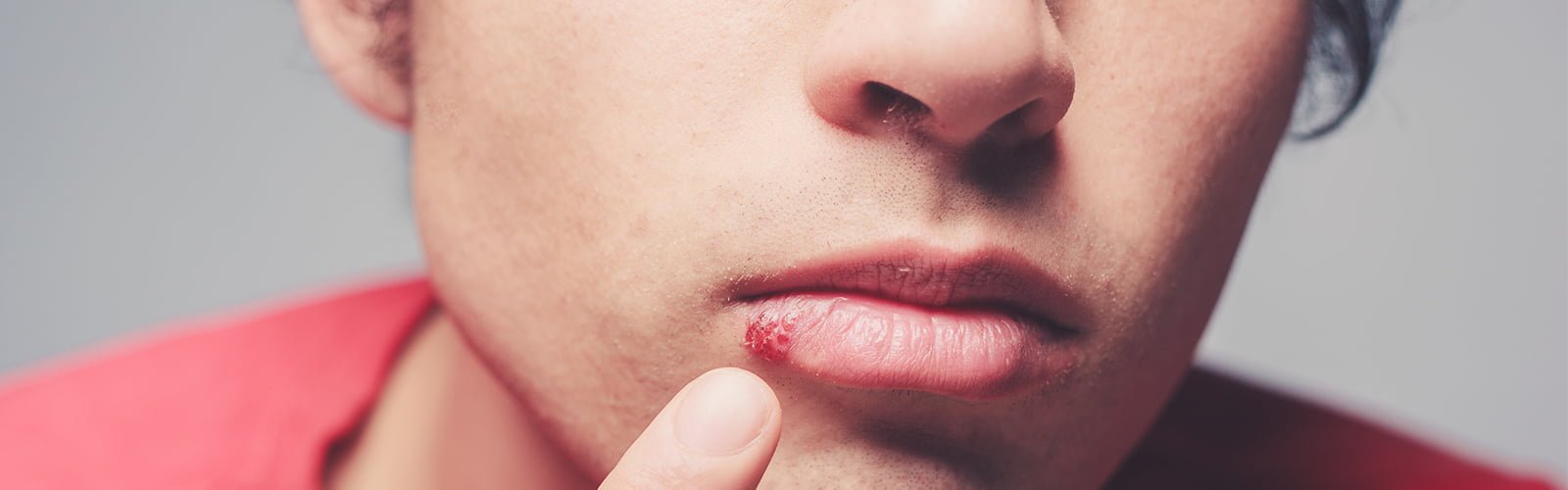 á? Do Herpes/Cold Sore Home Remedies Really Work?