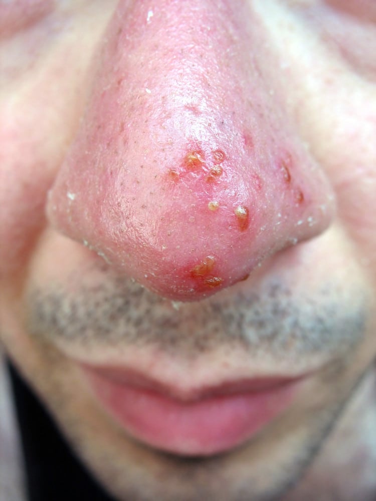 A medical condition closeup of the common coldsore virus herpes simplex ...