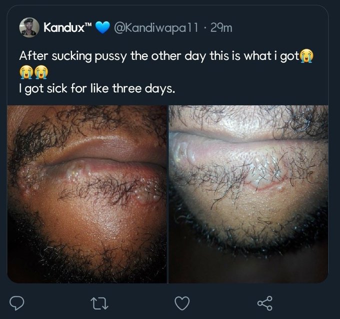After Eating A Pussy, He Got This!!!! (graphic Photo)