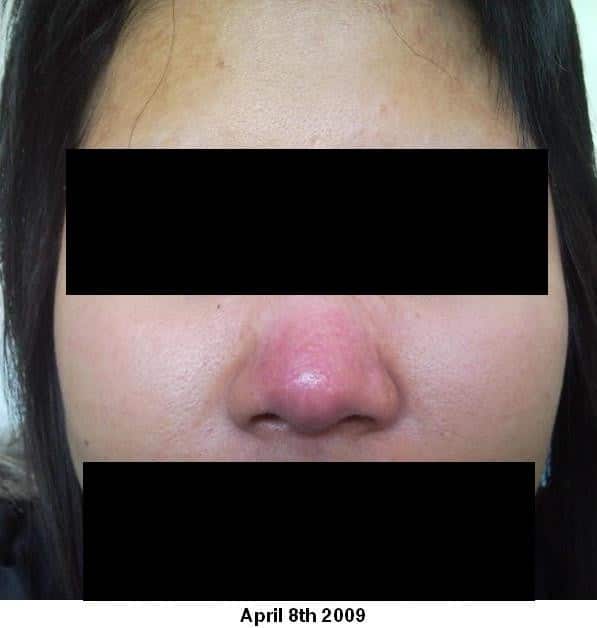An immunocompetent patient presenting with severe nasal herpes simplex ...