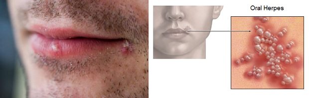 Are All Cold Sores A Form of Herpes?