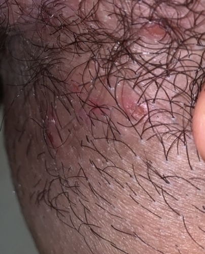 Bad candida or herpes? HELP pics included