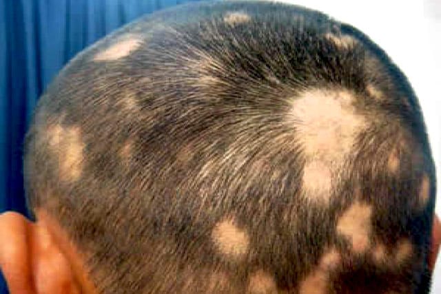 Best Alopecia treatment in delhi,India