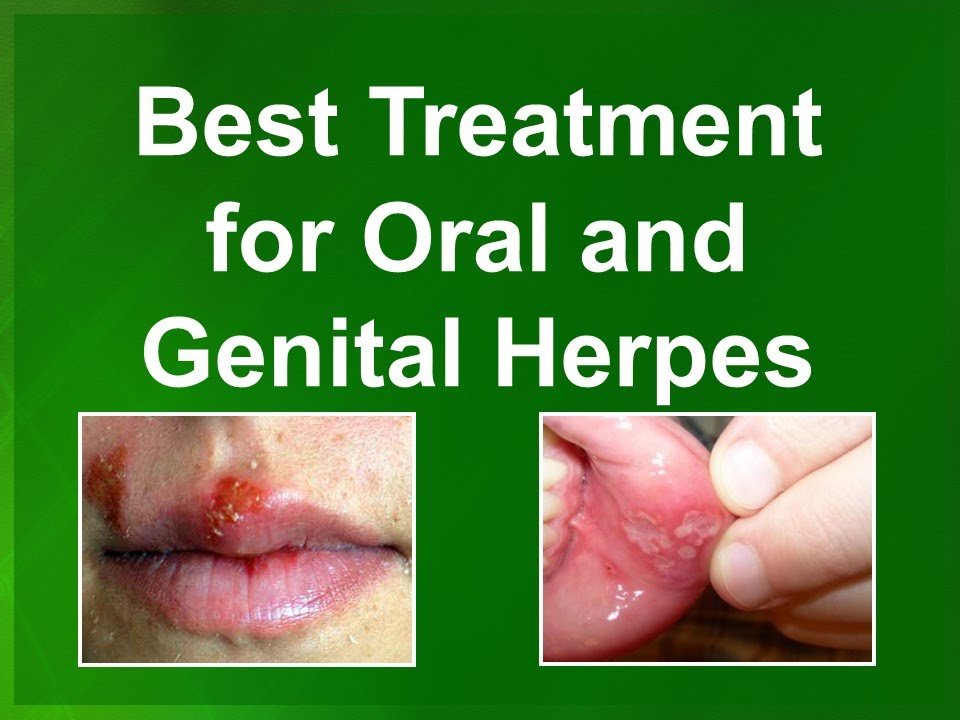 Best Genital Herpes Treatment Cure in New Orleans, LA ...