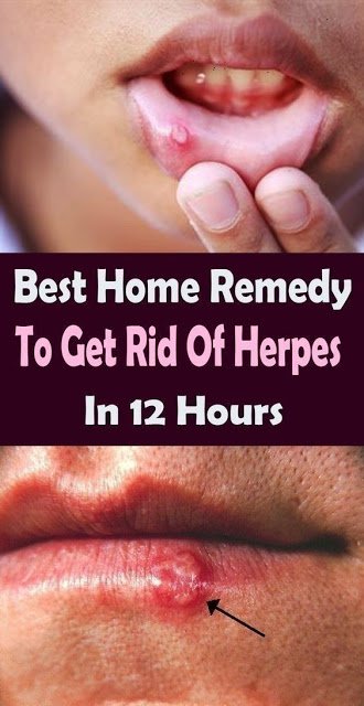 Best Home Remedy To Get Rid Of Herpes In 12 Hours