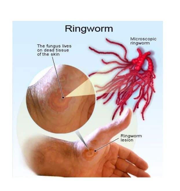 Beware of Ringworm