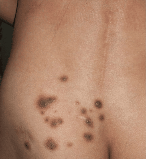 Brown papules and nodules on the lower back
