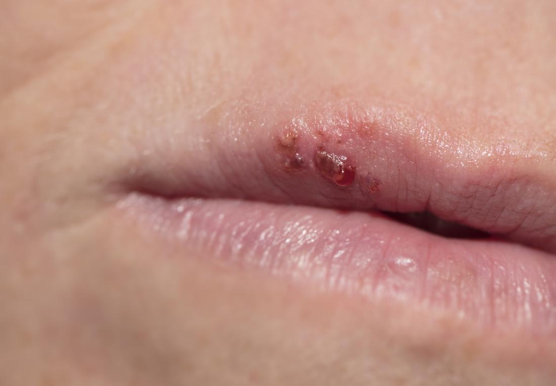 Bump on lip: Causes, treatment, and when to see a doctor