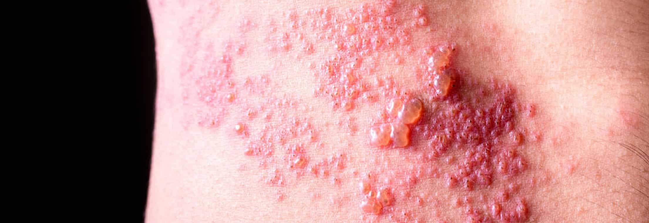 Can I Still Get Herpes Zoster (Shingles) After