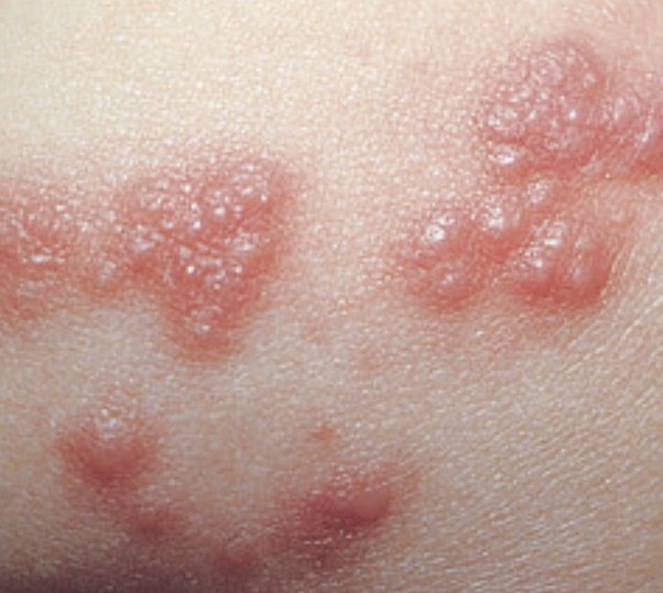 Can some essential oil cure herpes outbreaks?