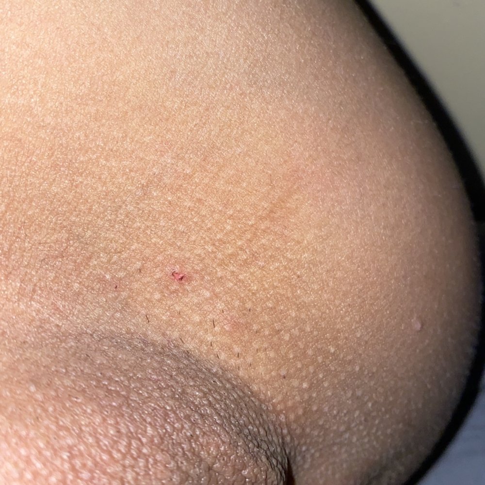 Can someone please help? Herpes??