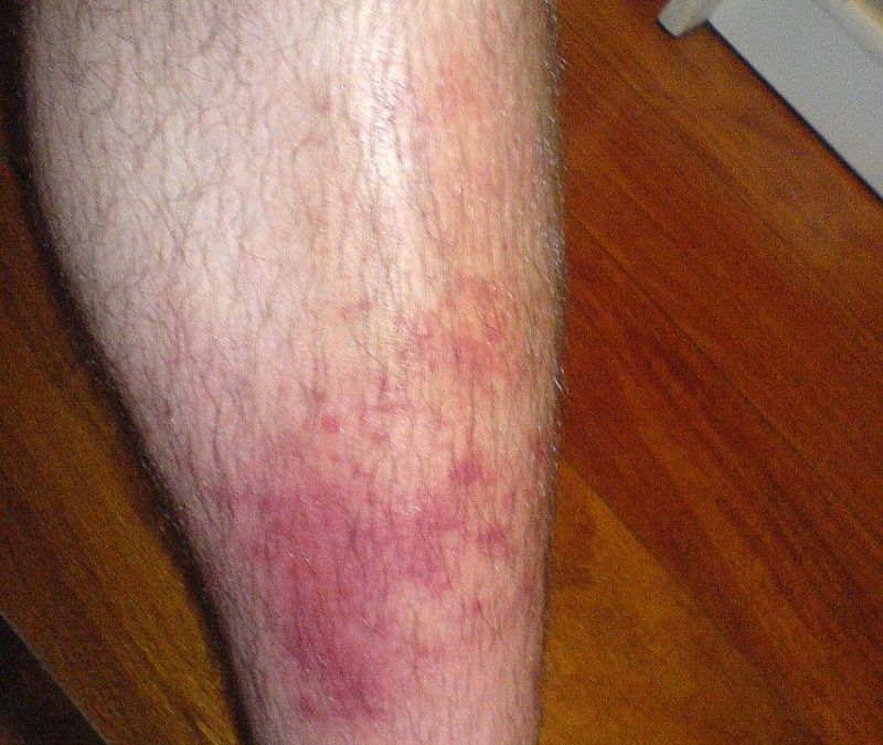 Cellulitis: A Common Skin Infection