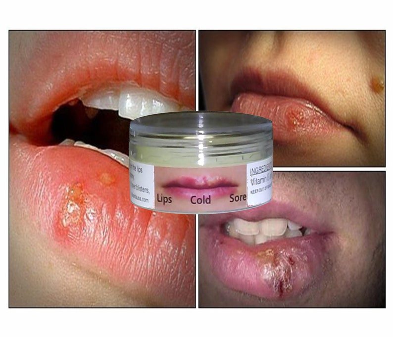 Cold Sore Blister Herpes Relief Remedy With Silica &  Aloe Vera