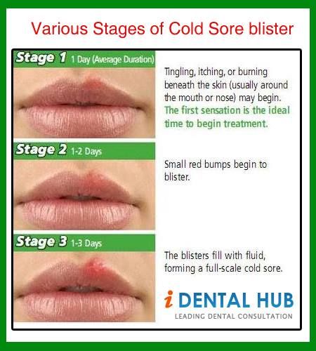 Cold Sore blisters are very common ailment and almost every body has ...