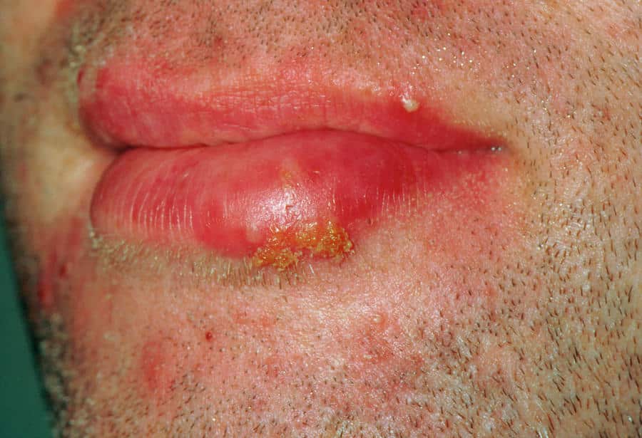 Cold Sore (herpes Simplex Lesion) On Patient