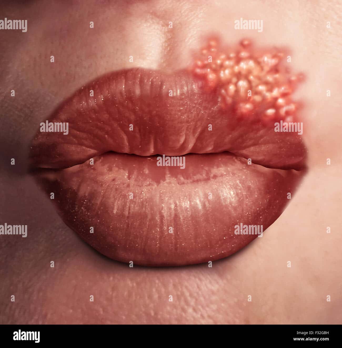 Cold sore herpes virus medical health concept as human lips with an ...