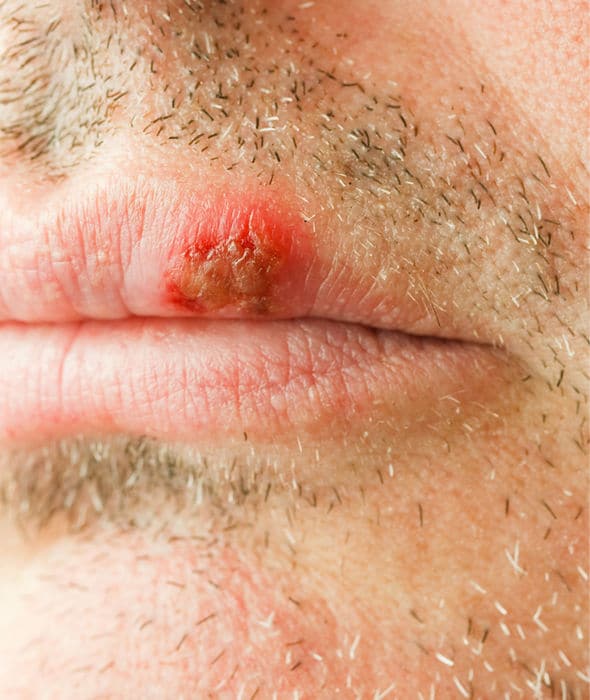 Cold sore: How to get rid of painful blisters