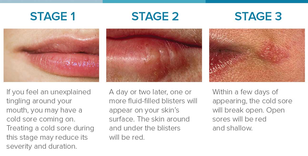 Cold Sore Stages: Identification and Treatment