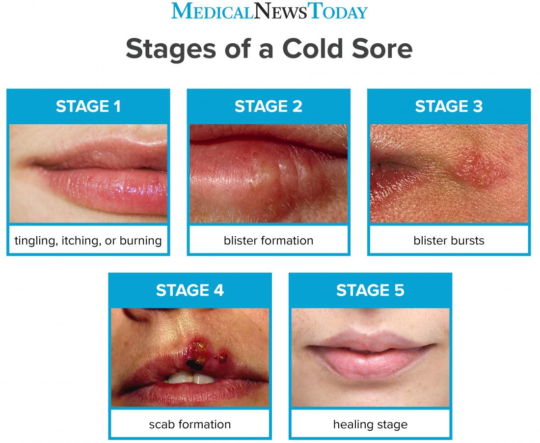 Cold sore stages: Pictures, duration, and treatment