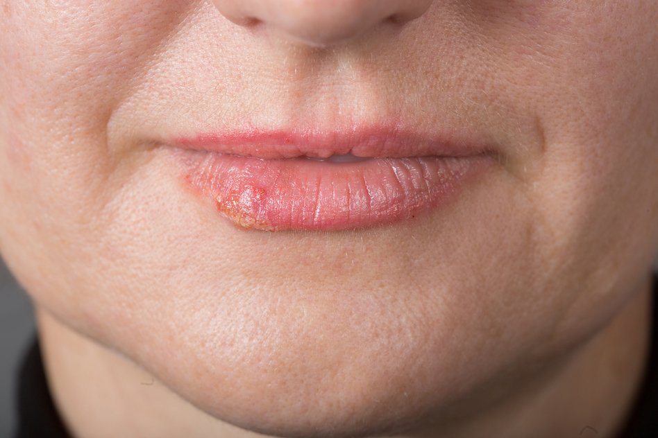 Cold Sores and Fever Blisters are Herpes