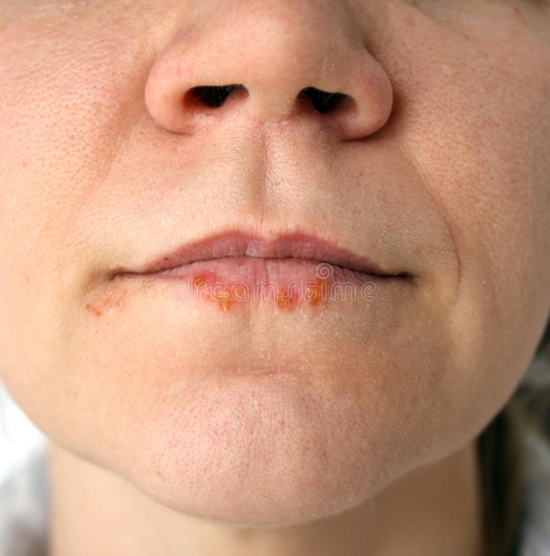 Cold Sores (herpes Labialis) Stock Photo