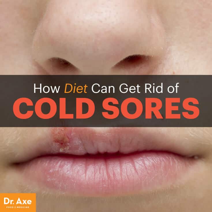 Cold Sores: How to Get Rid of Cold Sores Naturally