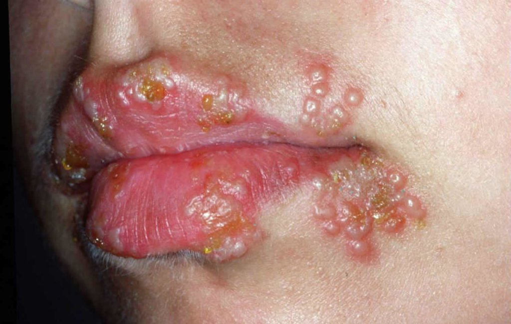 Cold sores, oral herpes, causes, prevention, symptoms &  treatment