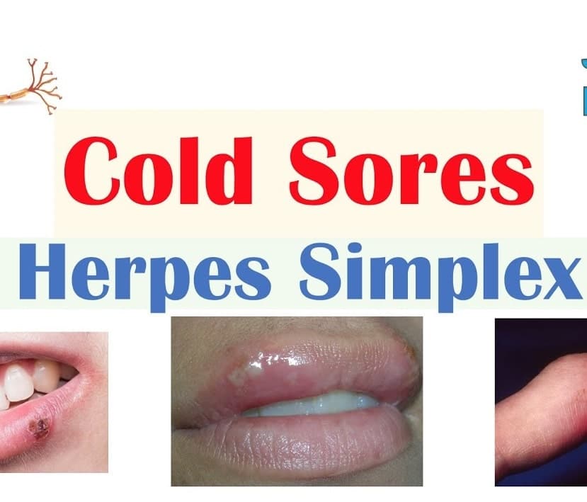 Cold Sores Oral Herpes Causes, Signs &  Symptoms, Treatment