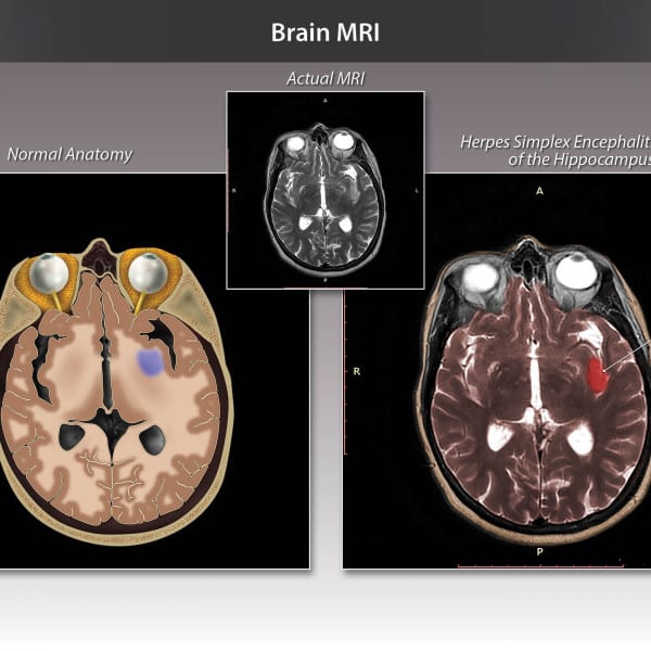 Colorized Brain MRI with Herpes Simplex Encephalitis