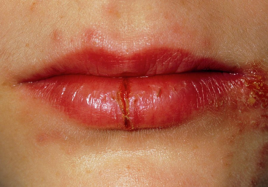 Cracked Lips Of Girl Affected By Herpes Simplex Photograph by Dr P ...