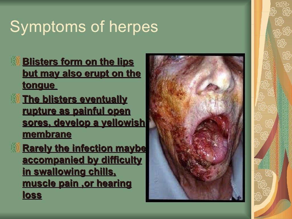 Definition of herpes