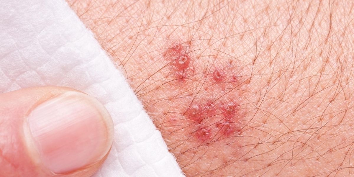 Disseminated Herpes: Definition, Cause, Symptoms and Treatments