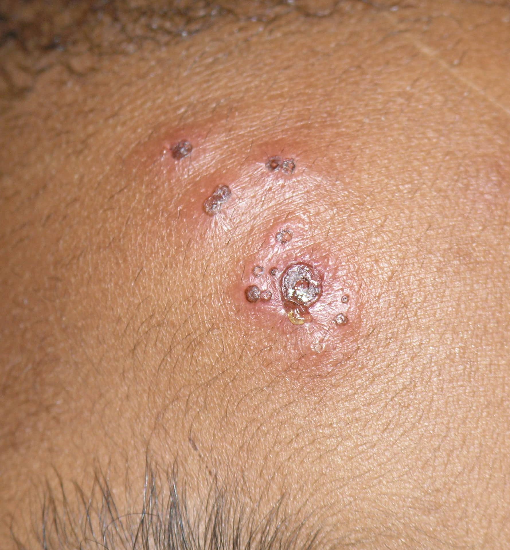 Do Herpes Outbreaks Happen In The Same Spot