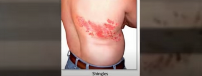 Do Shingles Rash Infection Follow Nerve Paths?