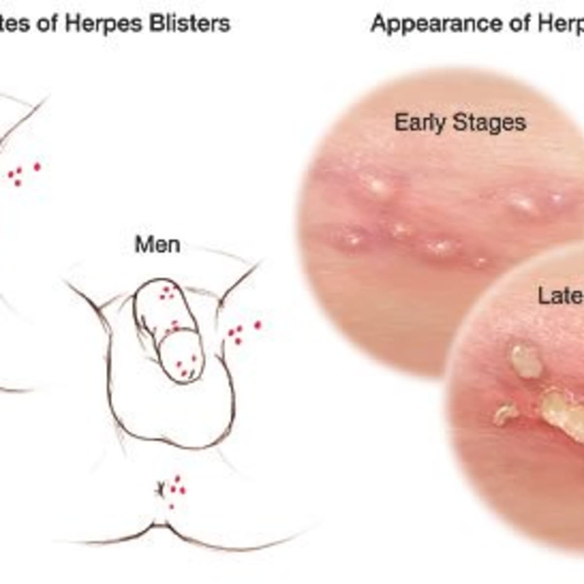 Early Hsv 1 Pictures / Hcfc1r1 Deficiency Blocks Herpes Simplex Virus 1 ...