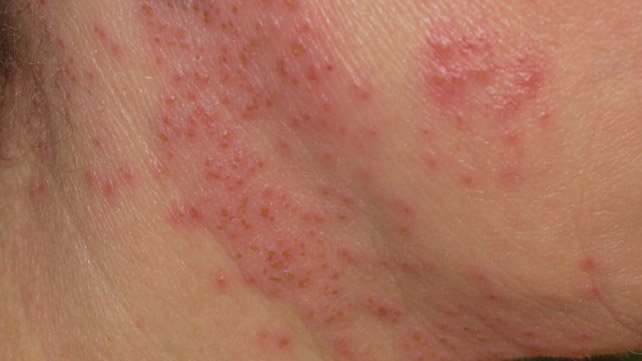 Eczema herpeticum: Symptoms, diagnosis, and treatment