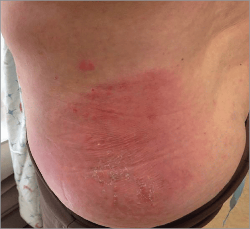 Erythematous Plaques on the Buttock