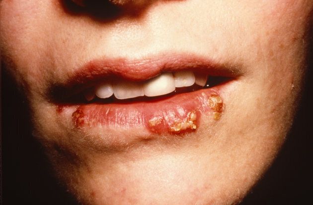 Everything You Need To Know About Herpes